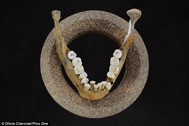 Lower jaw of an agriculturalist showing teeth overcrowding. 