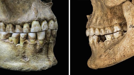 Side by side comparison of the teeth and jaws of a forager and an agriculturalist. 